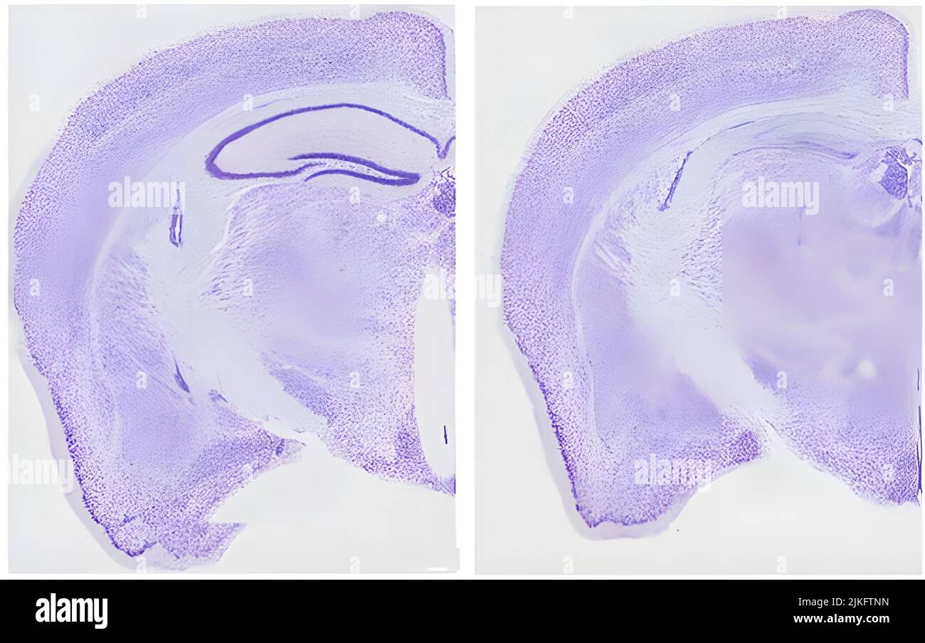 Brain sections from normal mice (left) and tauopathies (right). The dark purple lines in the left image represent the hippocampus, the area most responsible for learning and memory. This structure is almost completely absent in the image on the right. An NIH-funded mouse study identifies a possible therapeutic target for a family of neurodegenerative diseases. Stock Photo