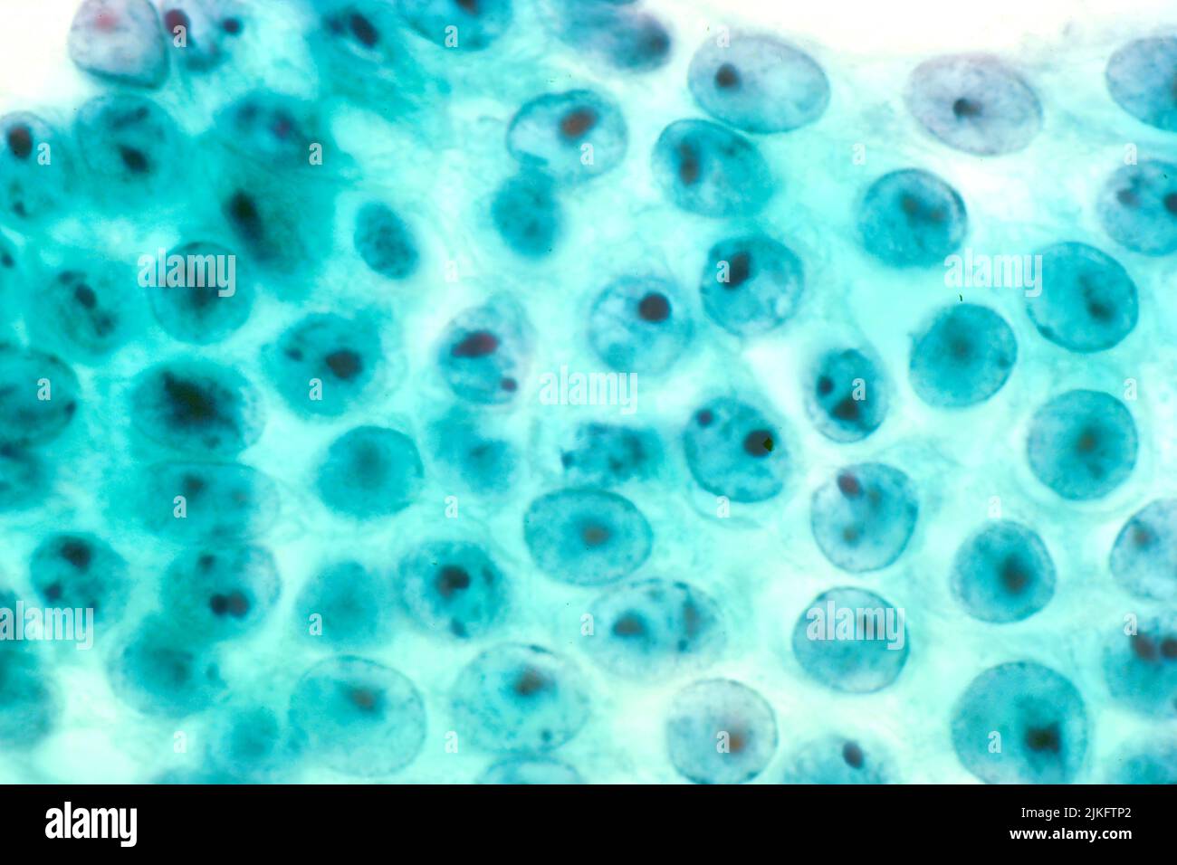 Reactive human stomach cells, which are not malignant. Stock Photo