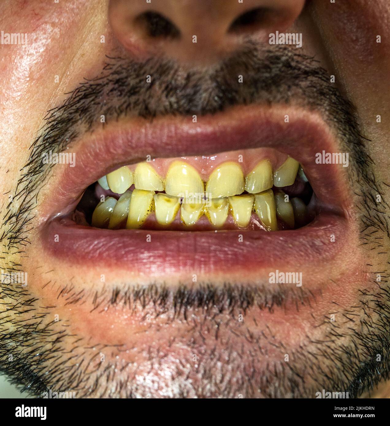 Crushed and broken teeth due to hard bite and constant consumption of