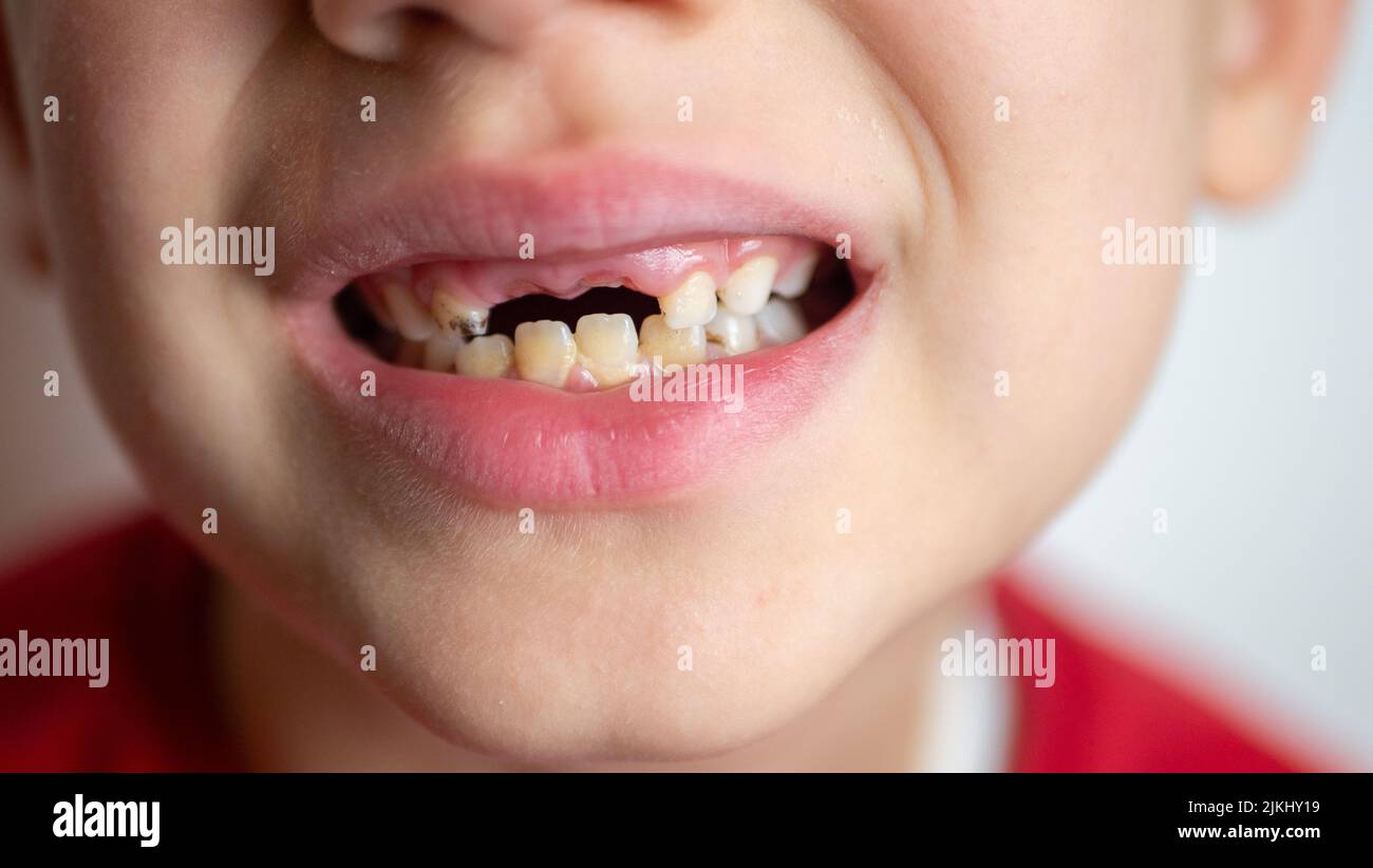 portrait of a boy with bad teeth, fallen front upper teeth Stock Photo