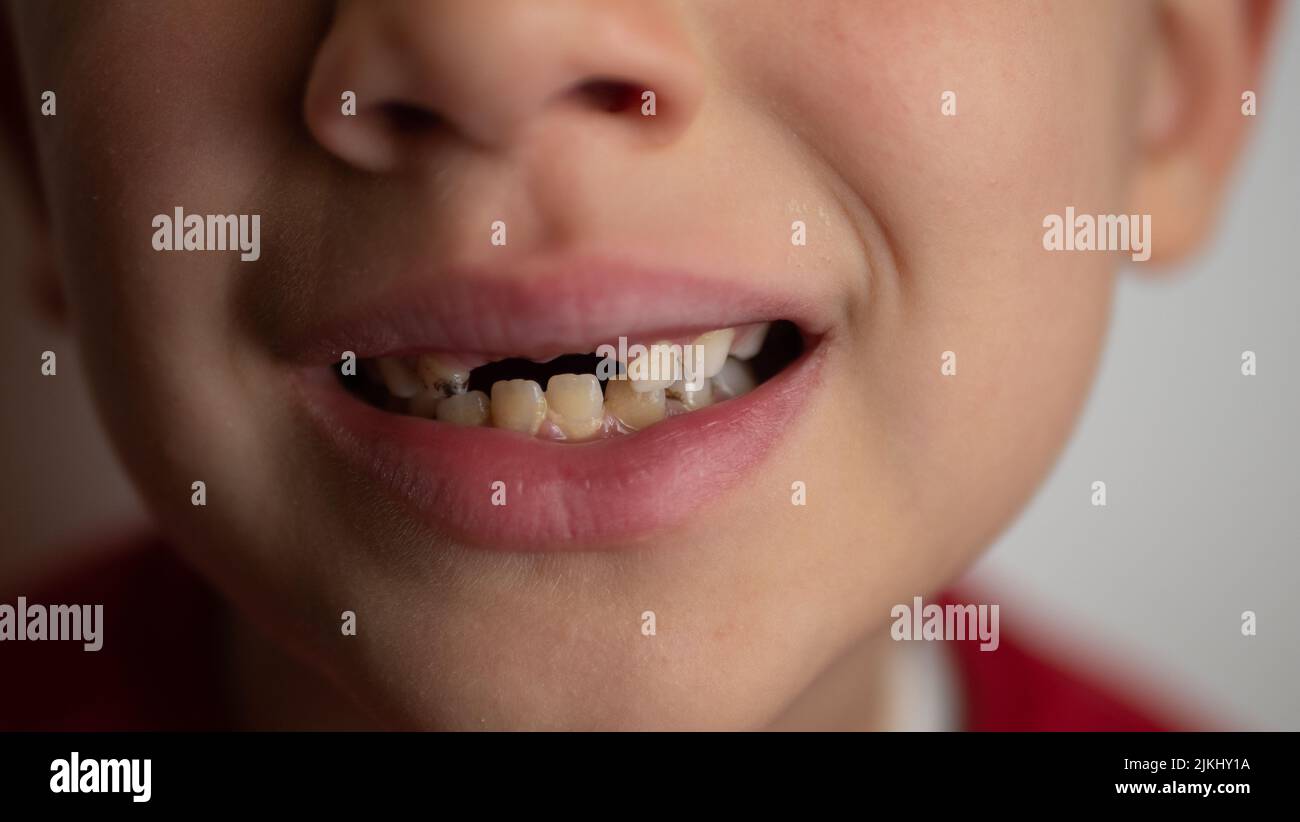 portrait of a boy with bad teeth, fallen front upper teeth Stock Photo