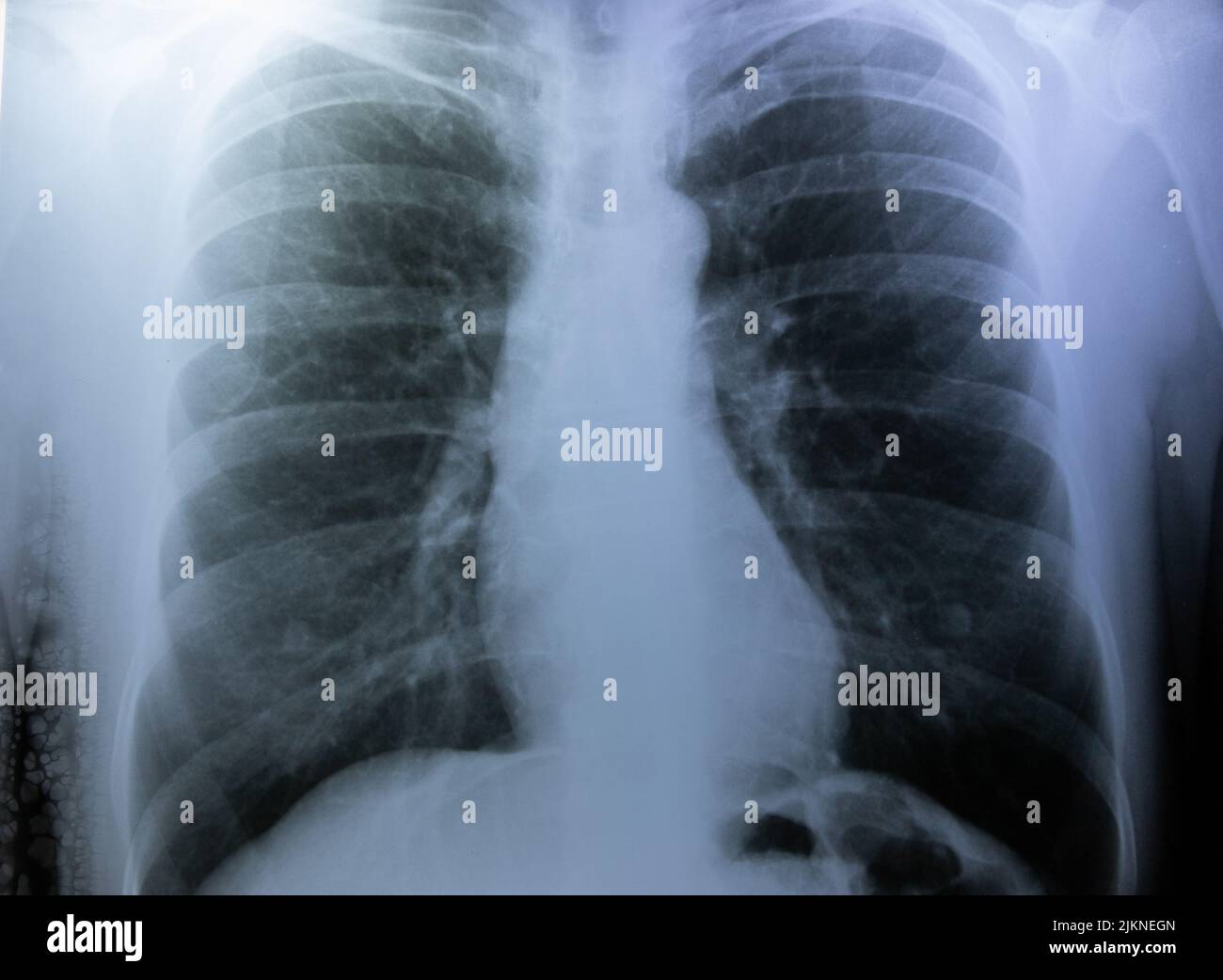 a closeup with x ray image of a human chest Stock Photo
