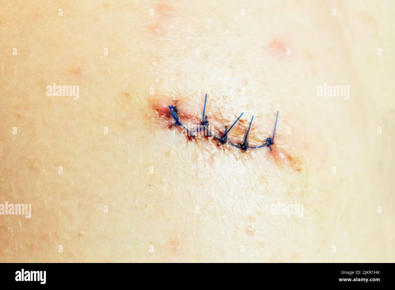 The modified purse-string suture: A useful technique for the repair of  cutaneous surgical wounds