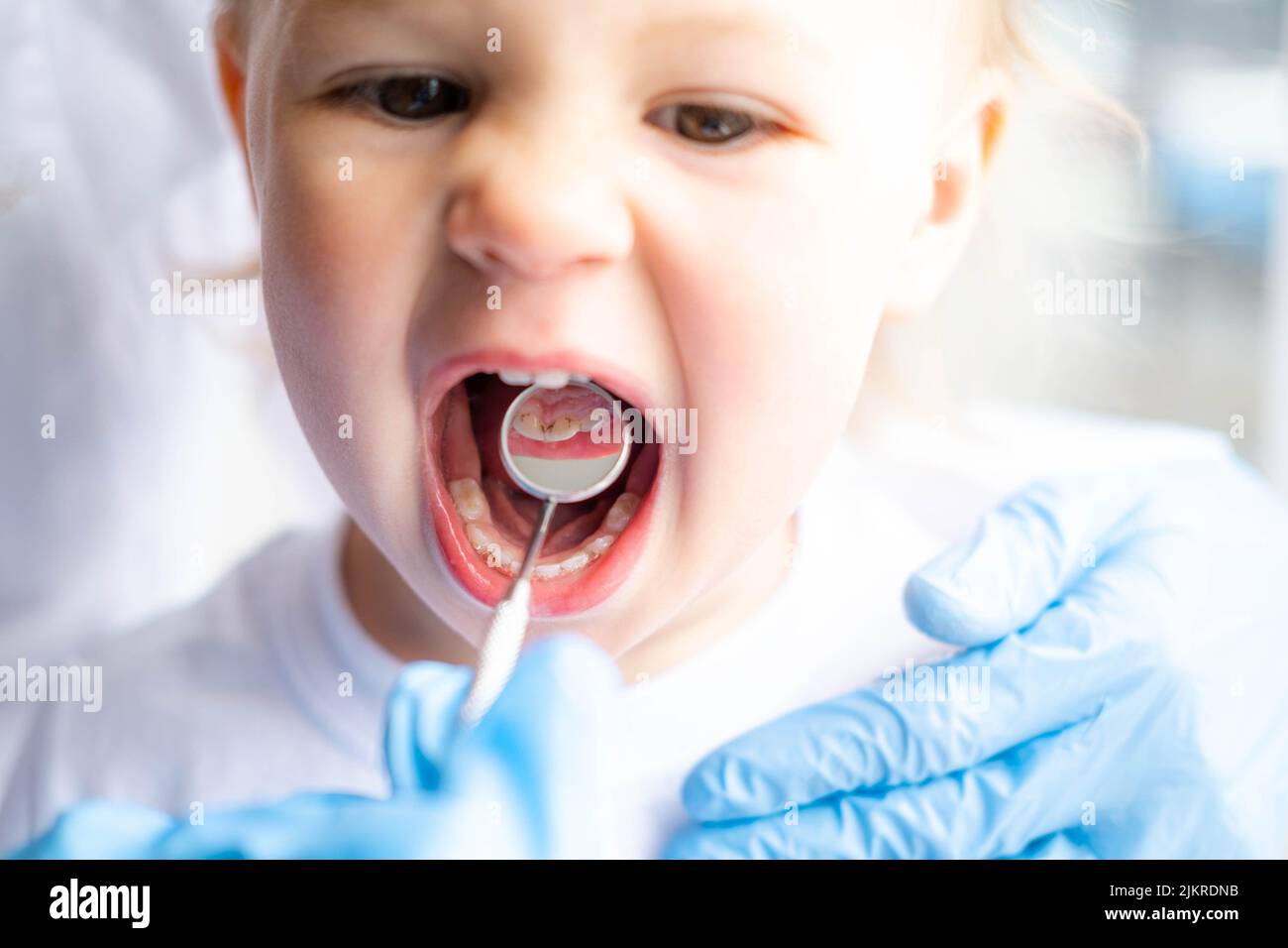 Closeup open mouth child and mirror in dentists hands in blue gloves
