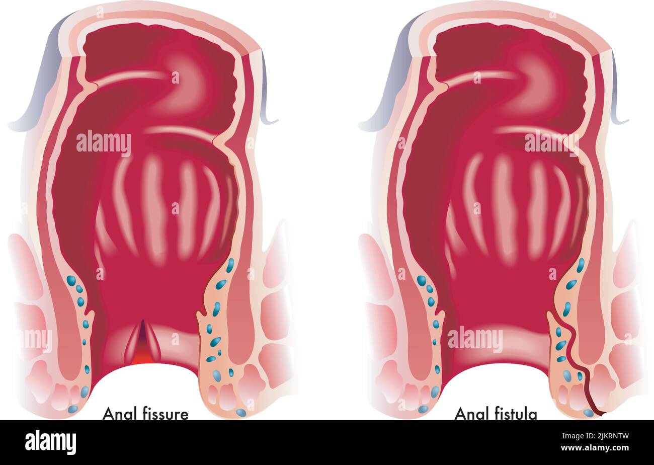 Medical illustration shows two common anal disorders, an anal fissure and an anal fistula. Stock Vector