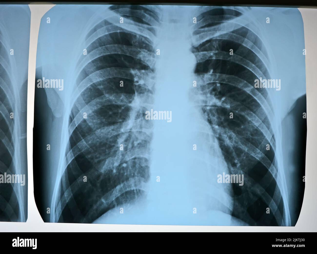 corona virus pneumonia test scanning, covid monkeypox roentgen x-rays radiography closeup diversity Stock Photo