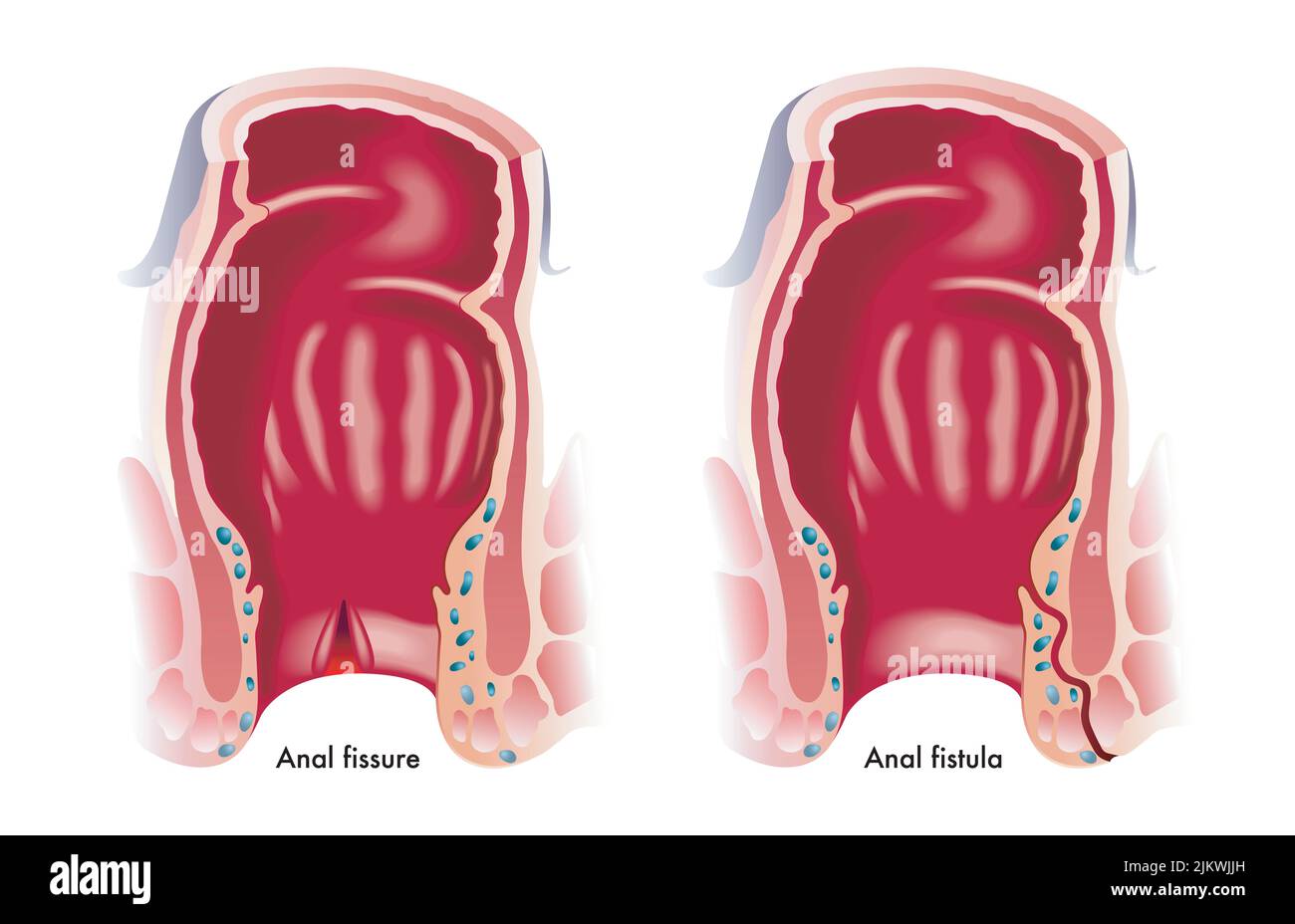 Medical illustration shows two common anal disorders, an anal fissure and an anal fistula. Stock Photo