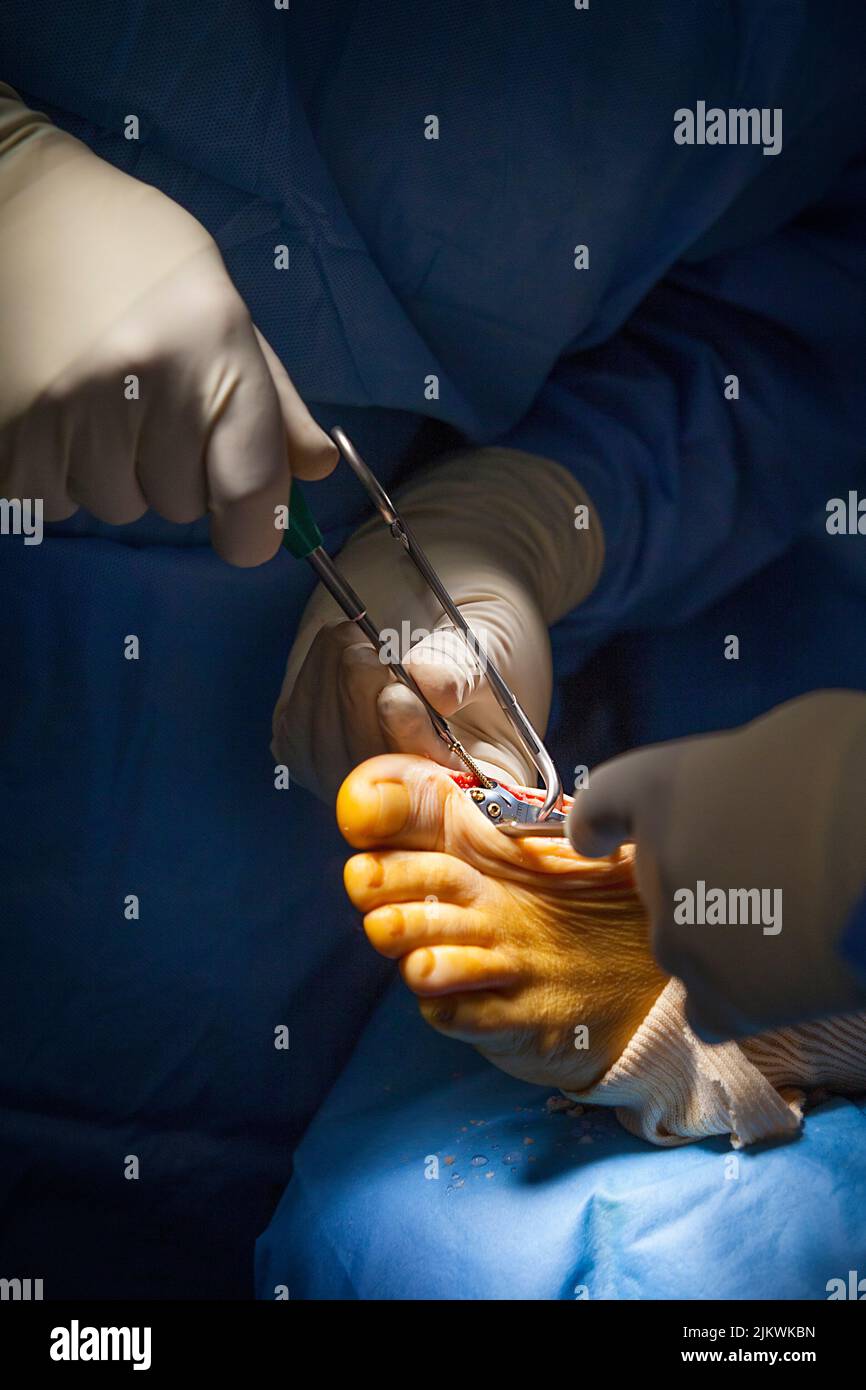 Orthopedic surgery operating room for arthrodesis of the big toe. Stock Photo