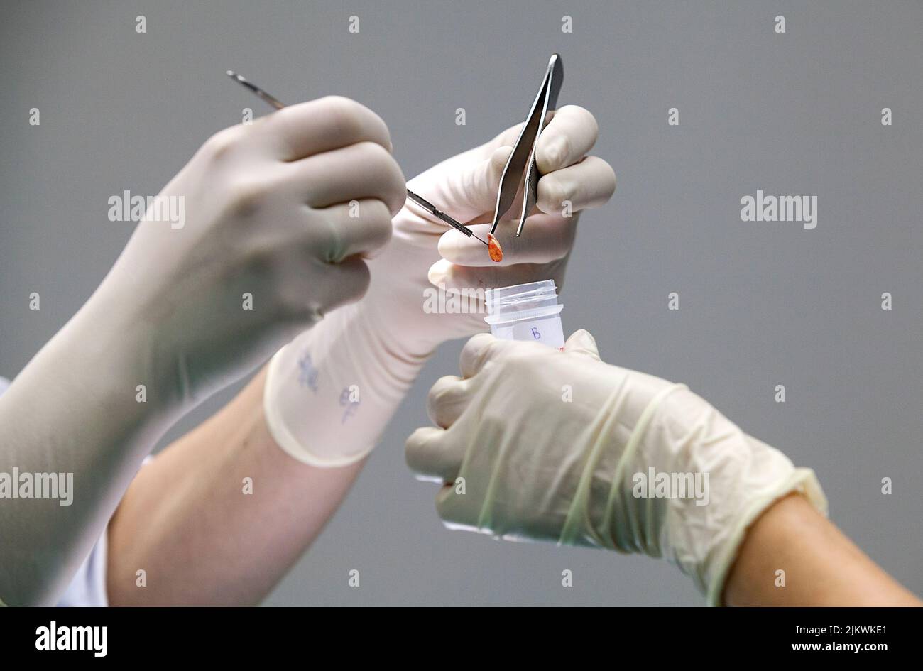The dermatologist takes samples from a suspicious mole. Stock Photo