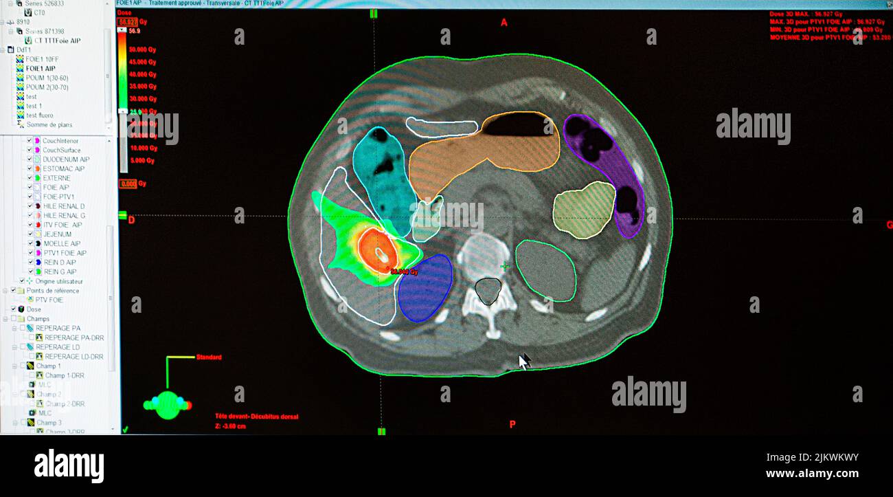 Treatment of a liver tumor with radiotherapy. Stock Photo