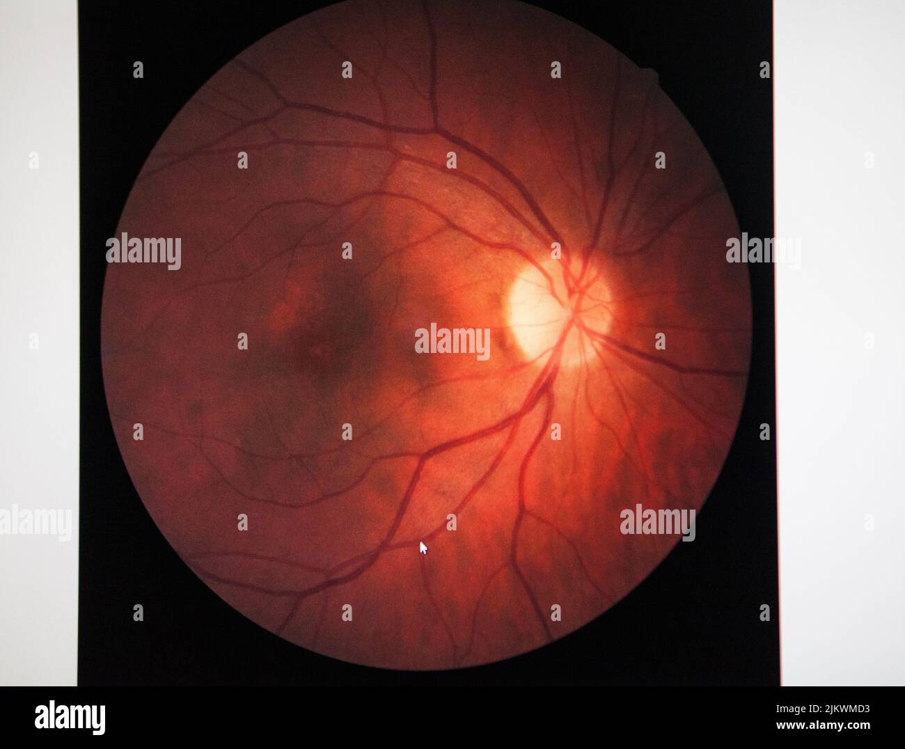 Fundus of a patient with macular edema. Stock Photo