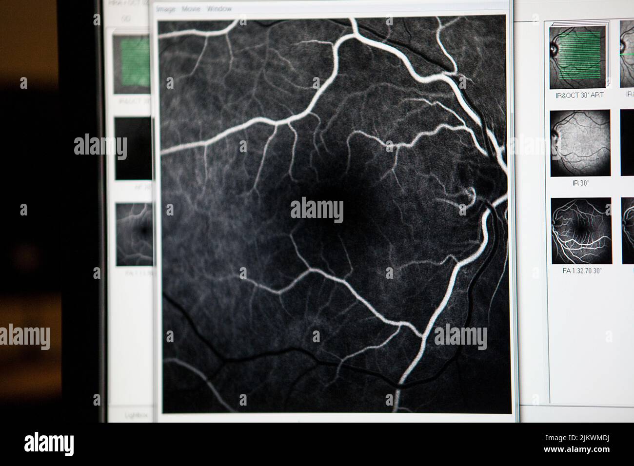 Angiofluorography of a patient at risk of glaucoma. Stock Photo