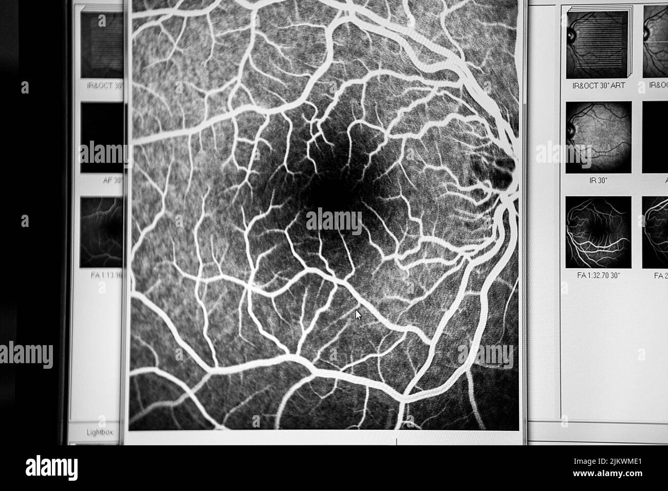 Angiofluorography of a patient at risk for glaucoma. Stock Photo