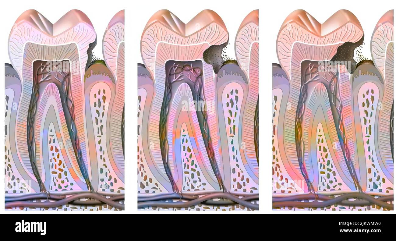Dental caries: progression of untreated decay that attacks the enamel. Stock Photo