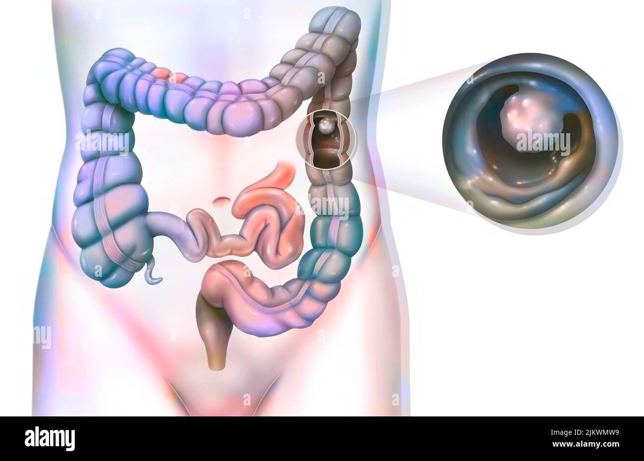 Digestive system: the colon with a colonic polyp. Stock Photo