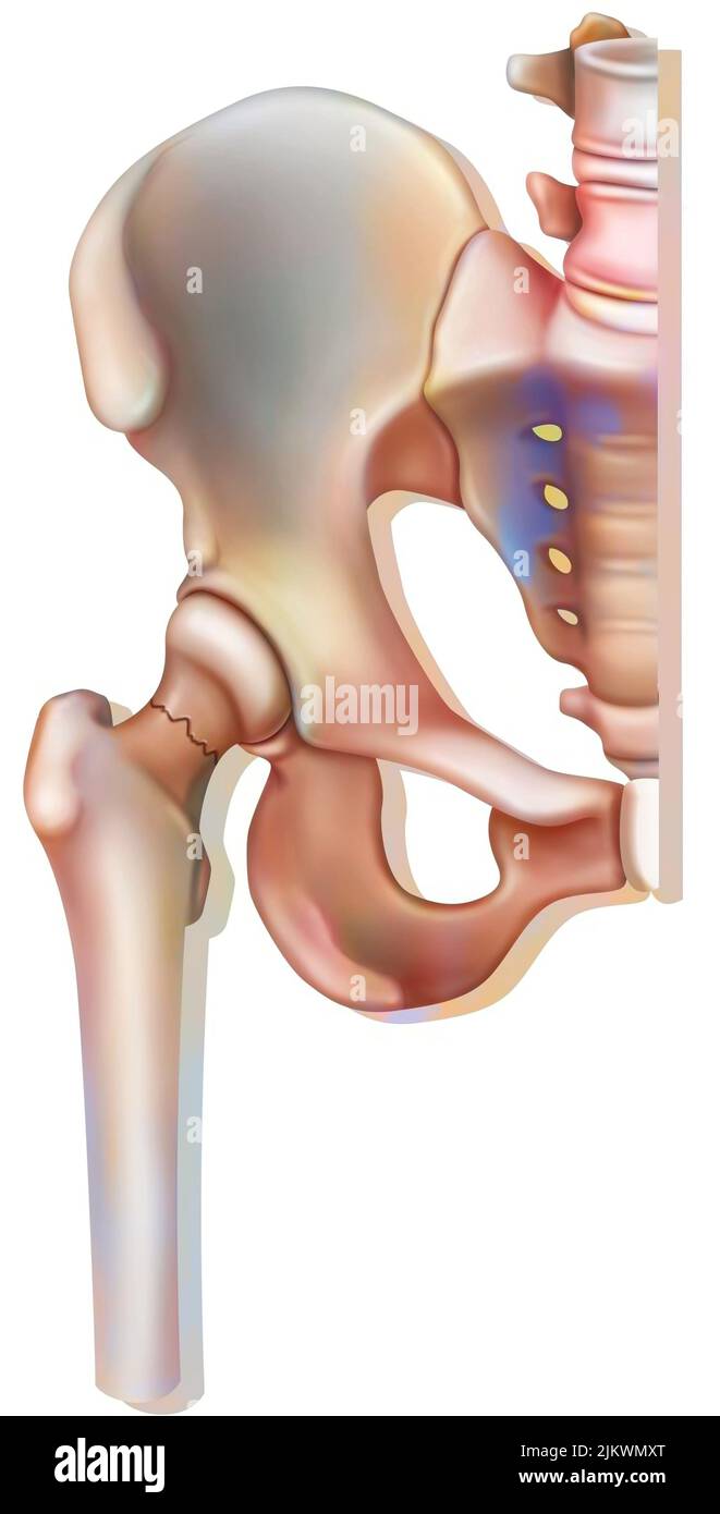 Bone system: fracture of the neck of the femur, linked to osteoporosis. Stock Photo