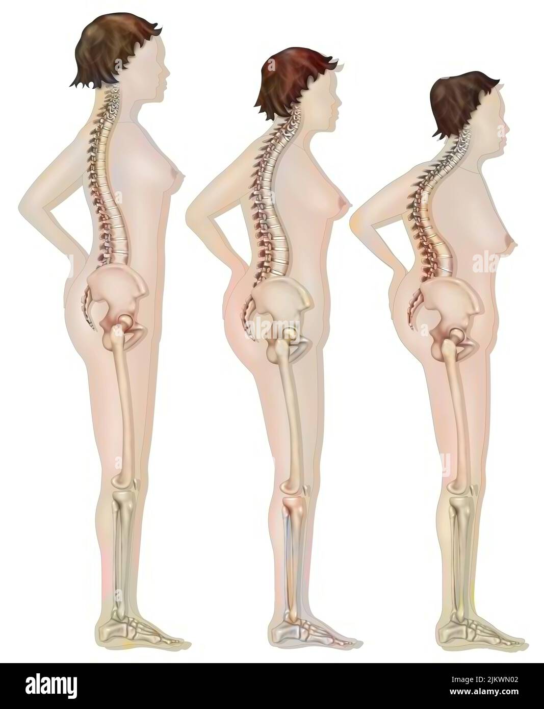 Modification of the silhouette linked to osteoporosis (vertebral compression). Stock Photo