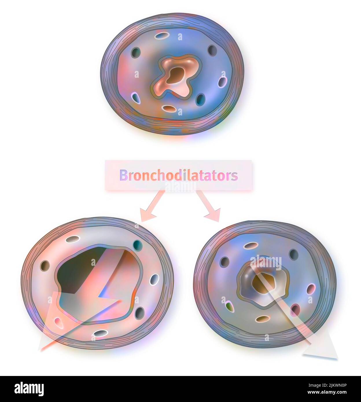 Bronchodilator on a bronchus with an asthma attack and COPD. Stock Photo