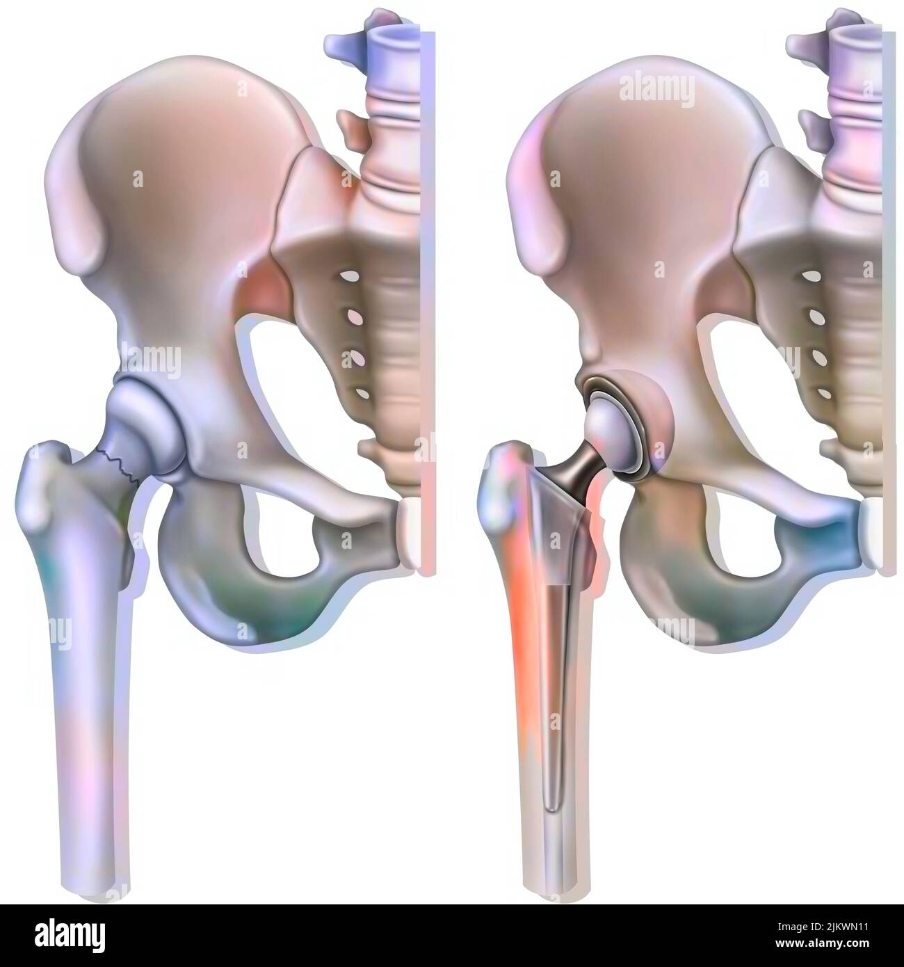 Femoral neck fracture (osteoporosis) and hip prosthesis. Stock Photo