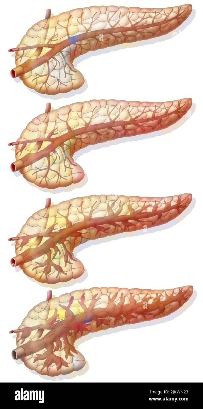 Evolution of the lesion of the pancreatic duct. Stock Photo