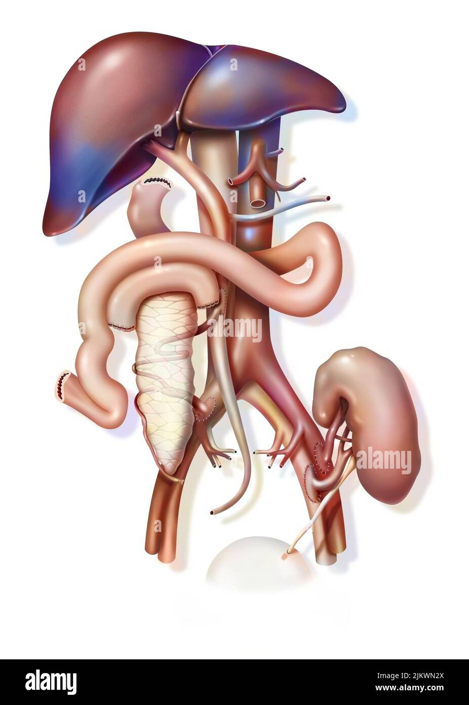Combined pancreas and kidney transplant: implantation of grafts. Stock Photo