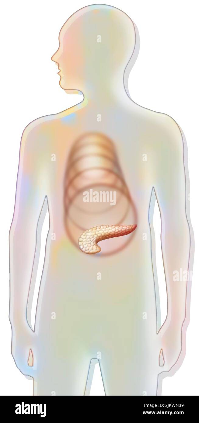 Pancreas: spread of pancreatic pain in the body. Stock Photo