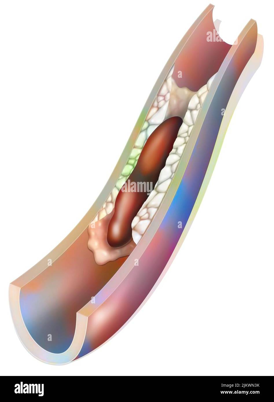 Artery with atheromatous plaque and a thrombus (blood clot). Stock Photo