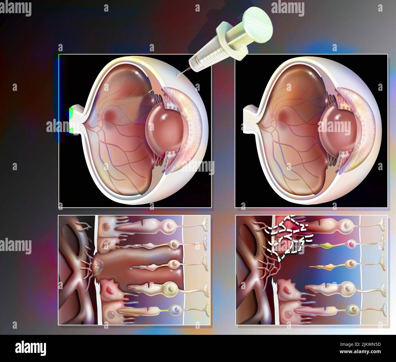 Eye treatment of macular degeneration by RNA interference Stock Photo