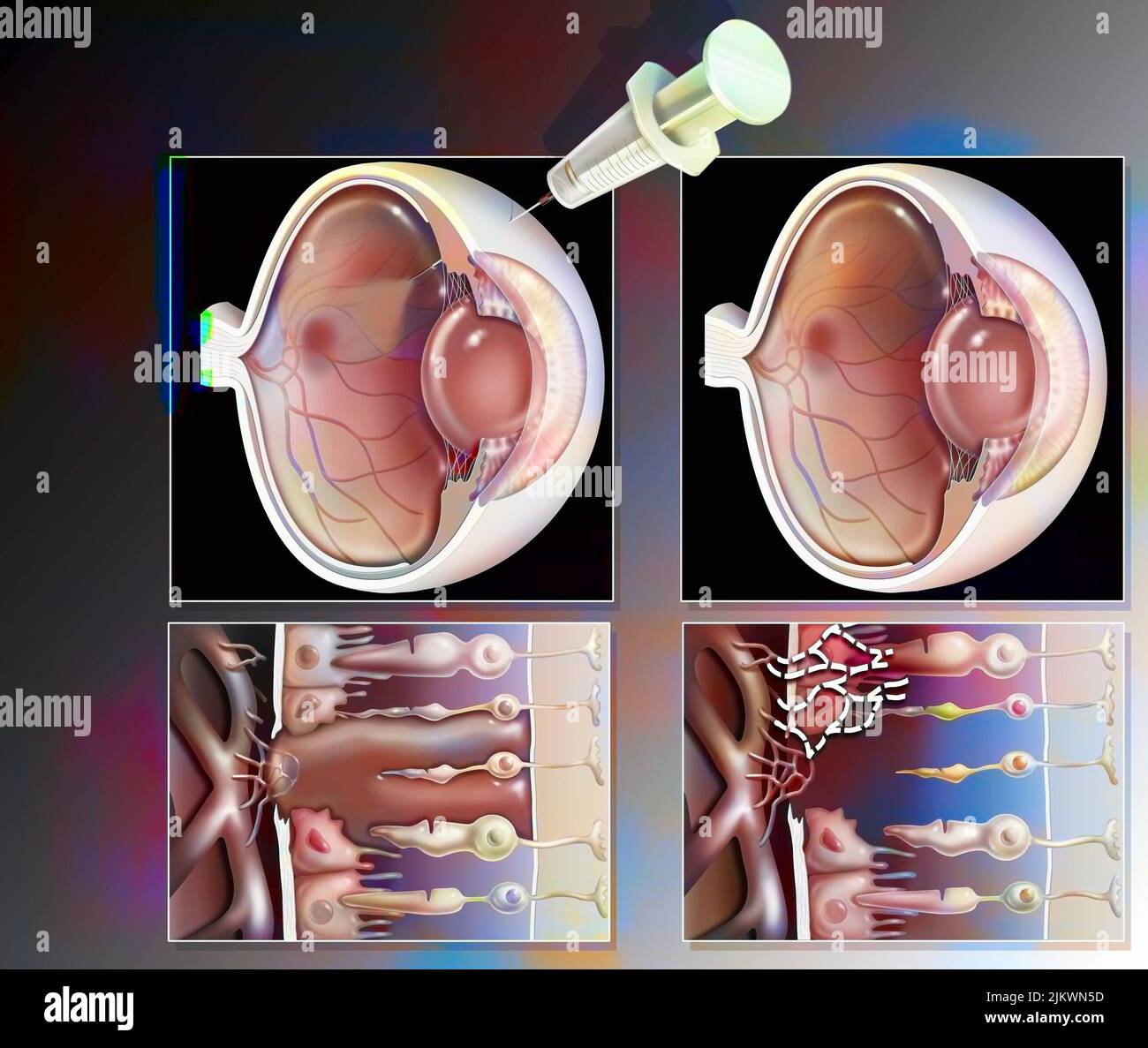 Eye: treatment of macular degeneration by RNA interference. Stock Photo