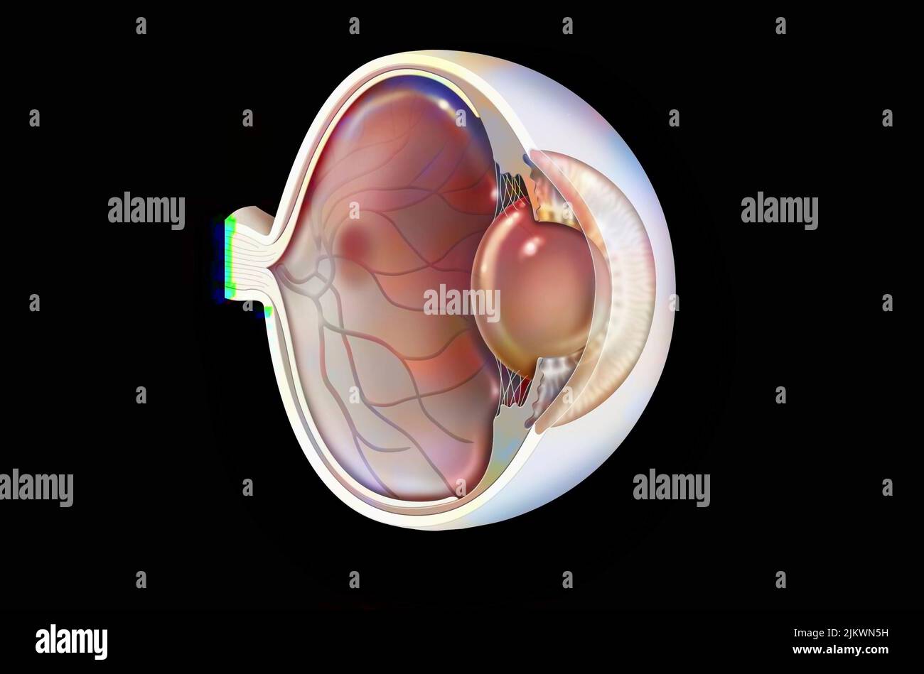 Eye: age-related macular degeneration (degenerative disease of the macula). Stock Photo