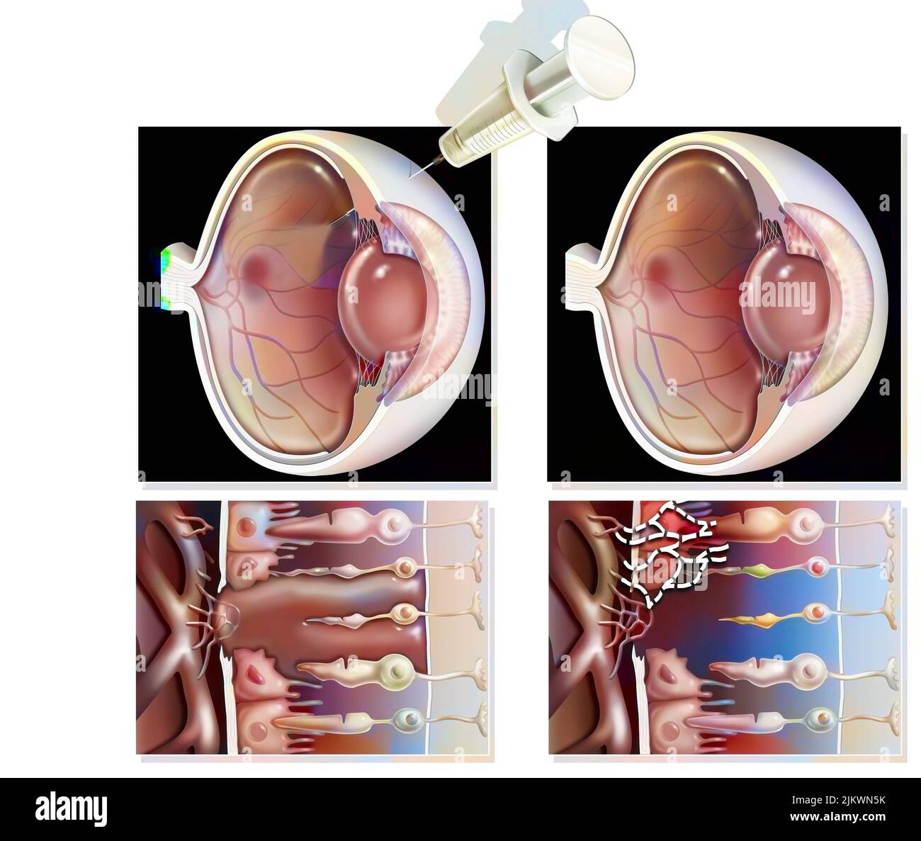 Eye: treatment of macular degeneration by RNA interference. Stock Photo