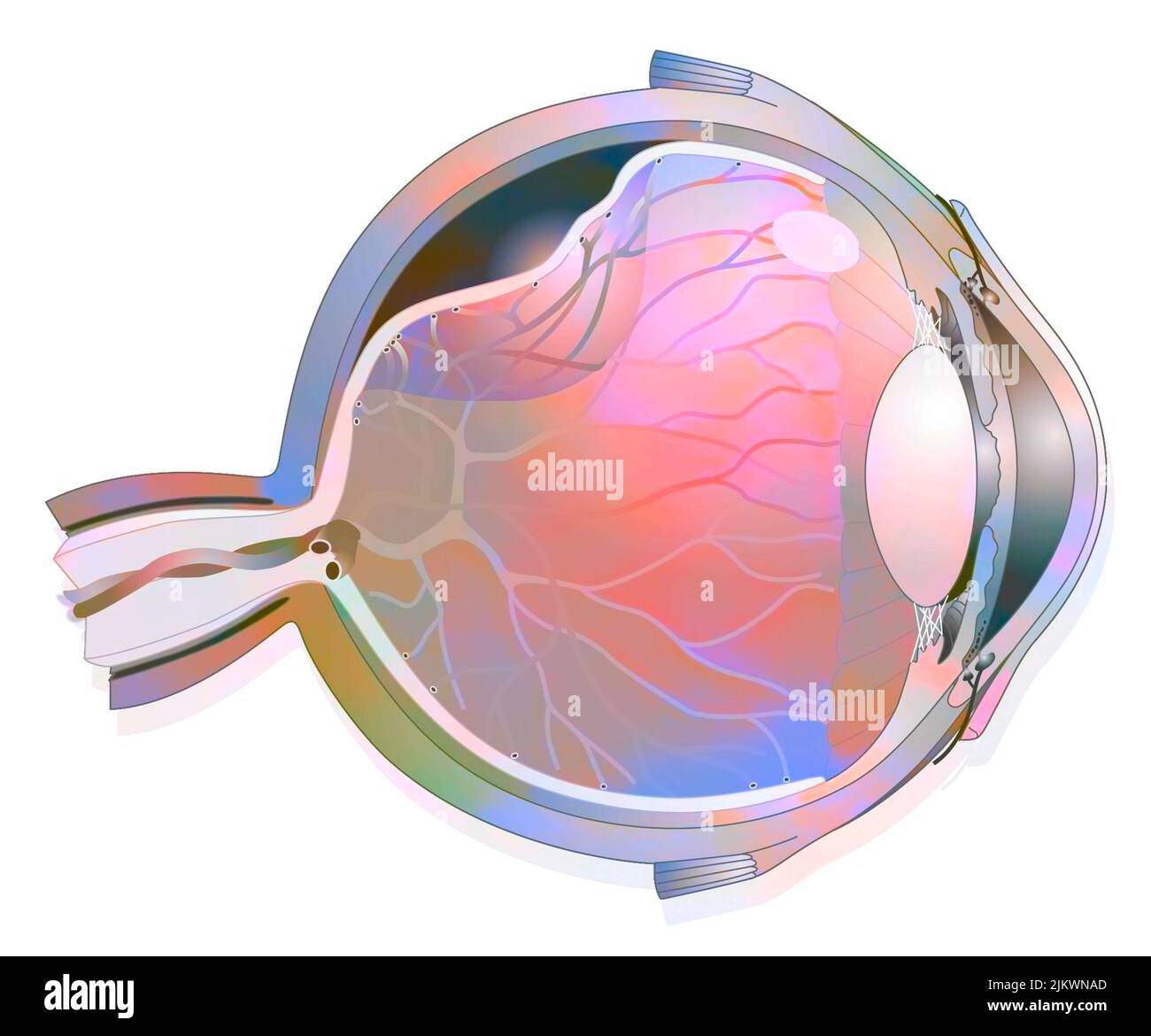 Eye: detachment of the retina, which detaches from the underlying choroid. Stock Photo