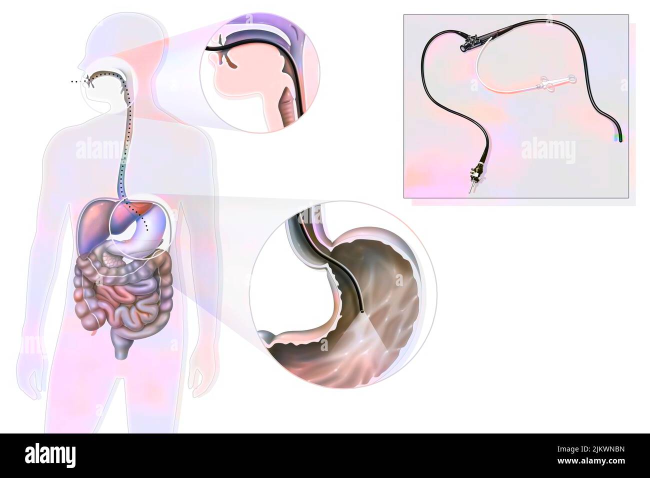 Gastroscopy: route and location of the gastro fiberscope introduced through the mouth. Stock Photo