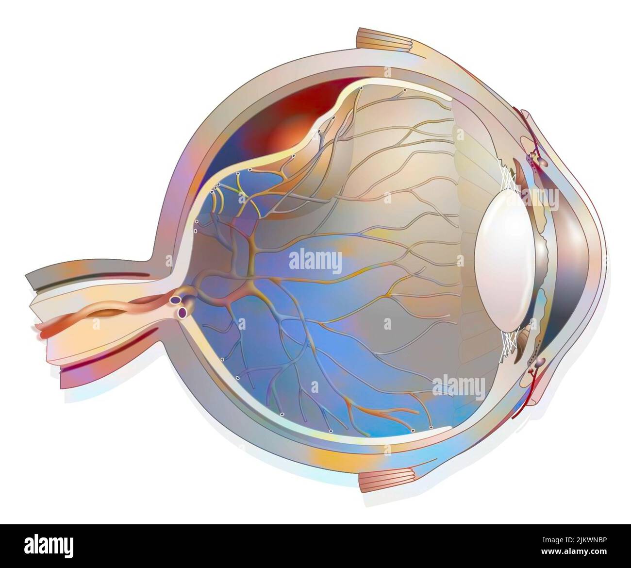 Eye: detachment of the retina, which detaches from the underlying choroid. Stock Photo