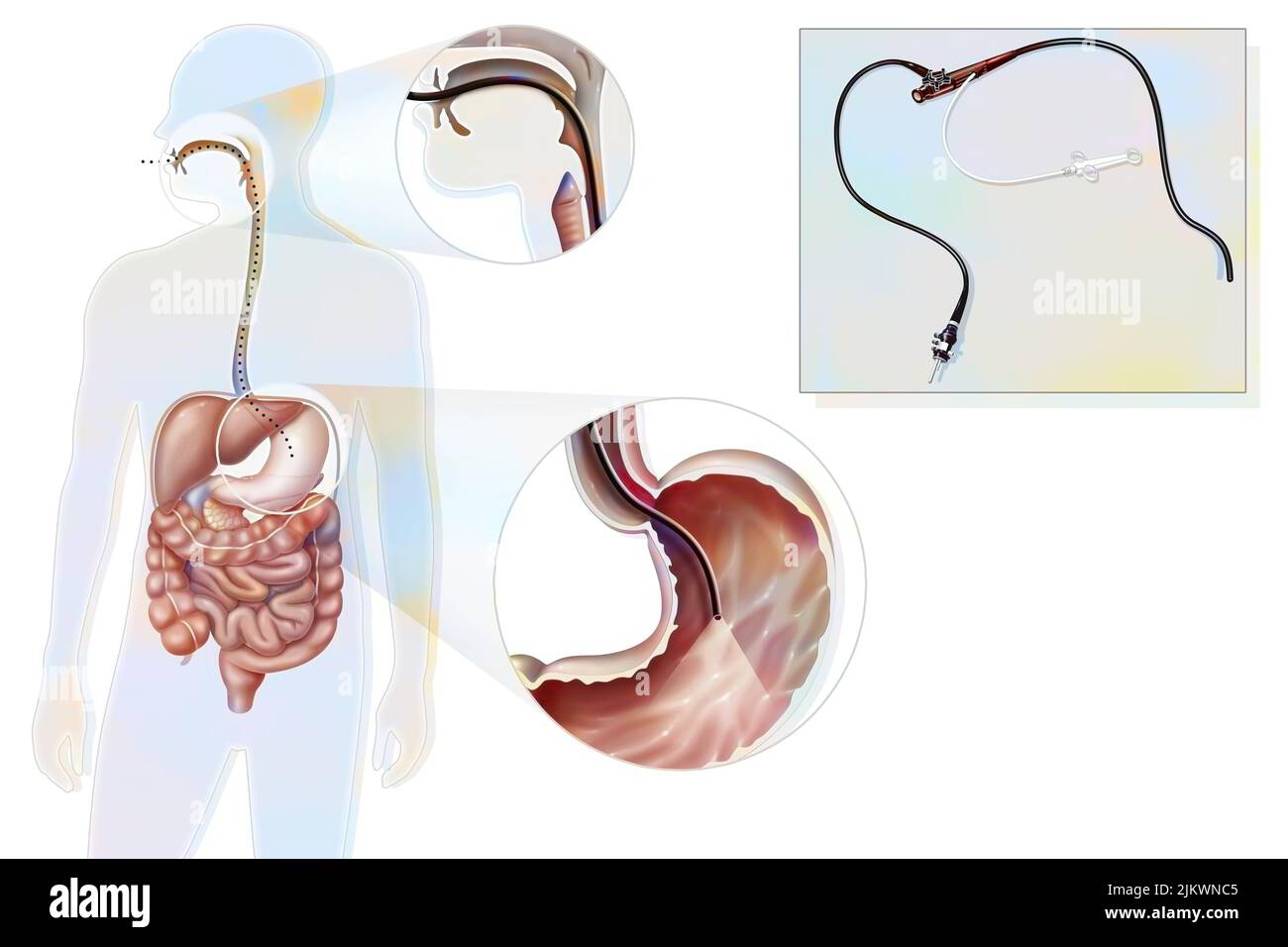 Gastroscopy: route and location of the gastro fiberscope introduced through the mouth. Stock Photo
