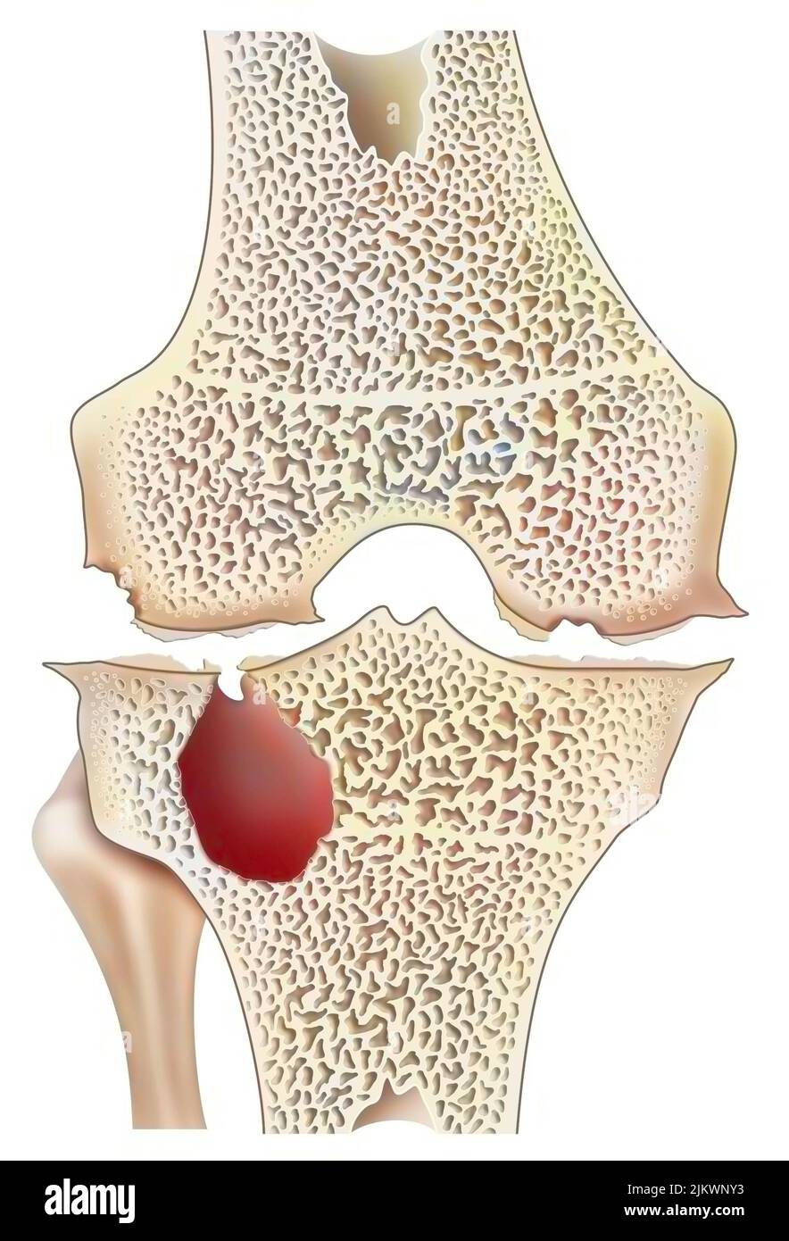 Knee with hemophilic arthropathy with marginal joint erosion. Stock Photo