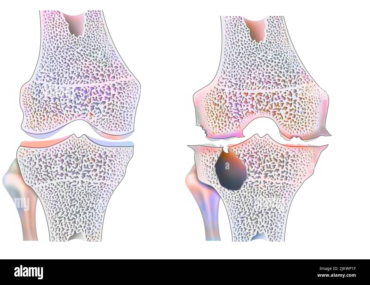 Healthy knee with hemophilic arthropathy with marginal joint erosion. Stock Photo