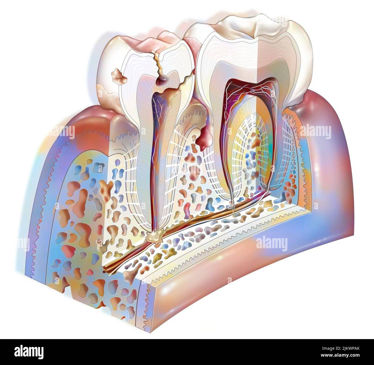 Dental plaque: main pathologies of the teeth: tartar, gingivitis, decay. Stock Photo
