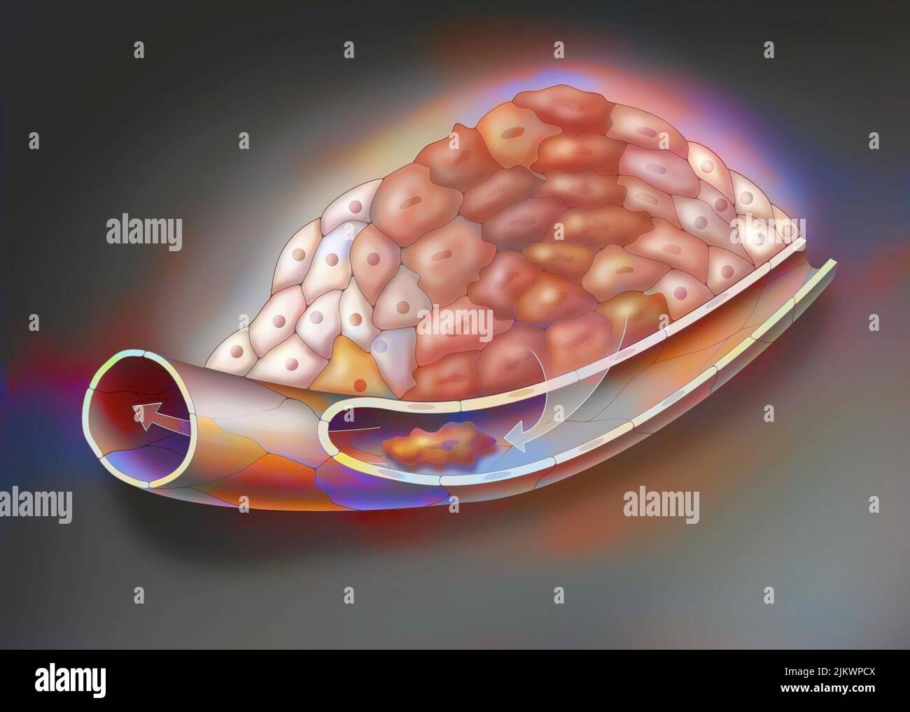 Cancerous tumor, stage 3: Cancer cells have multiplied and transformed. Stock Photo