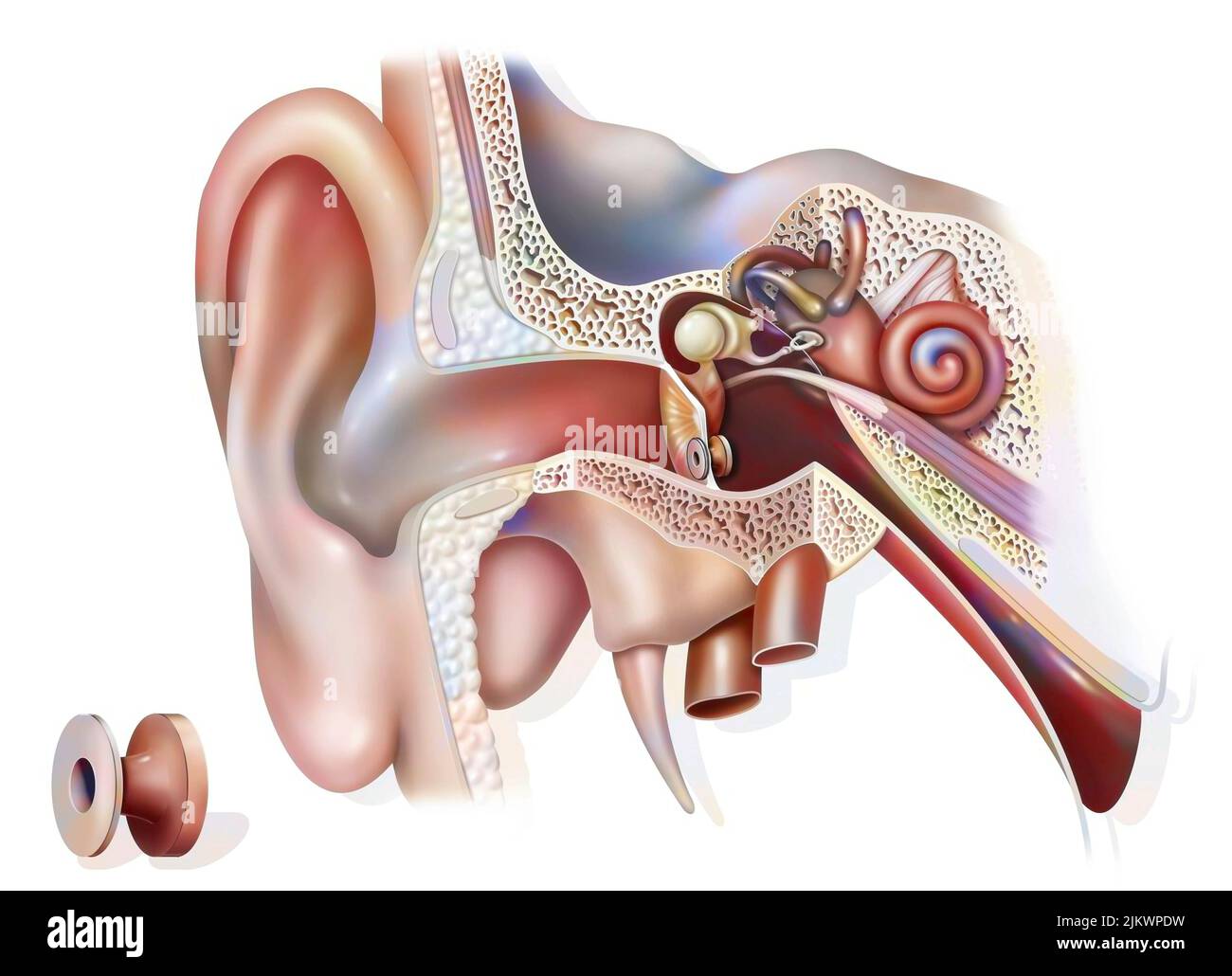 Otitis treatment: tympanic ventilator in the ear to promote ventilation of the ear. Stock Photo