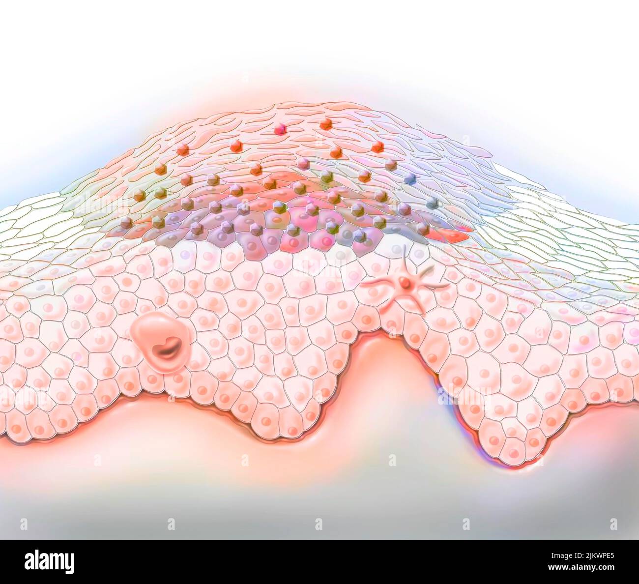 Wart, benign skin tumor caused by human papillomavirus virus Stock