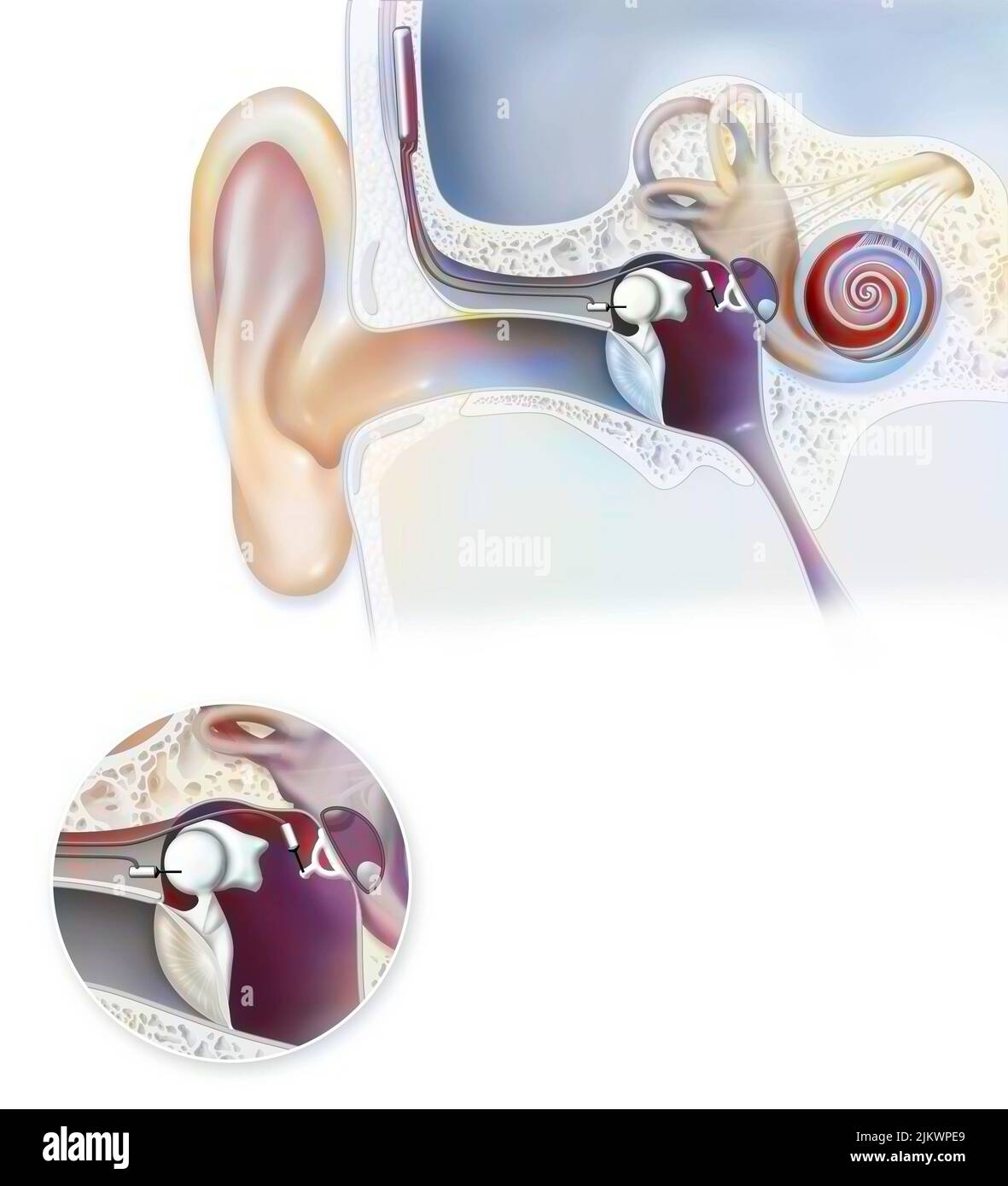 Ear: hearing aid (Esteem) implantable in the inner ear. Stock Photo