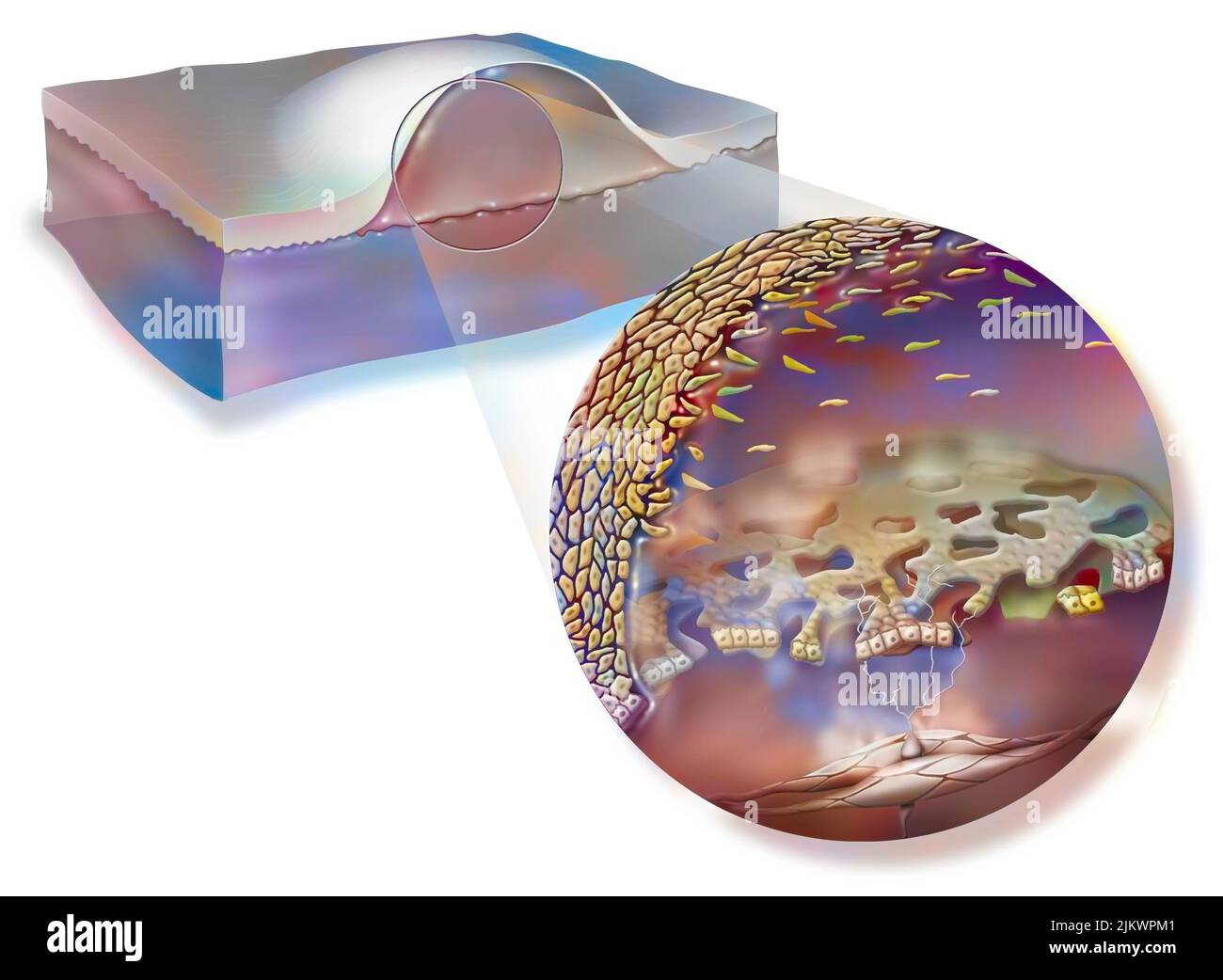 A blister (skin blister) is a bubble under the skin filled with plasma