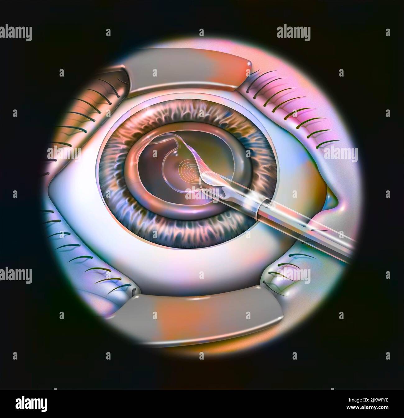 Treatment of presbyopia by introducing a multifocal implant to replace
