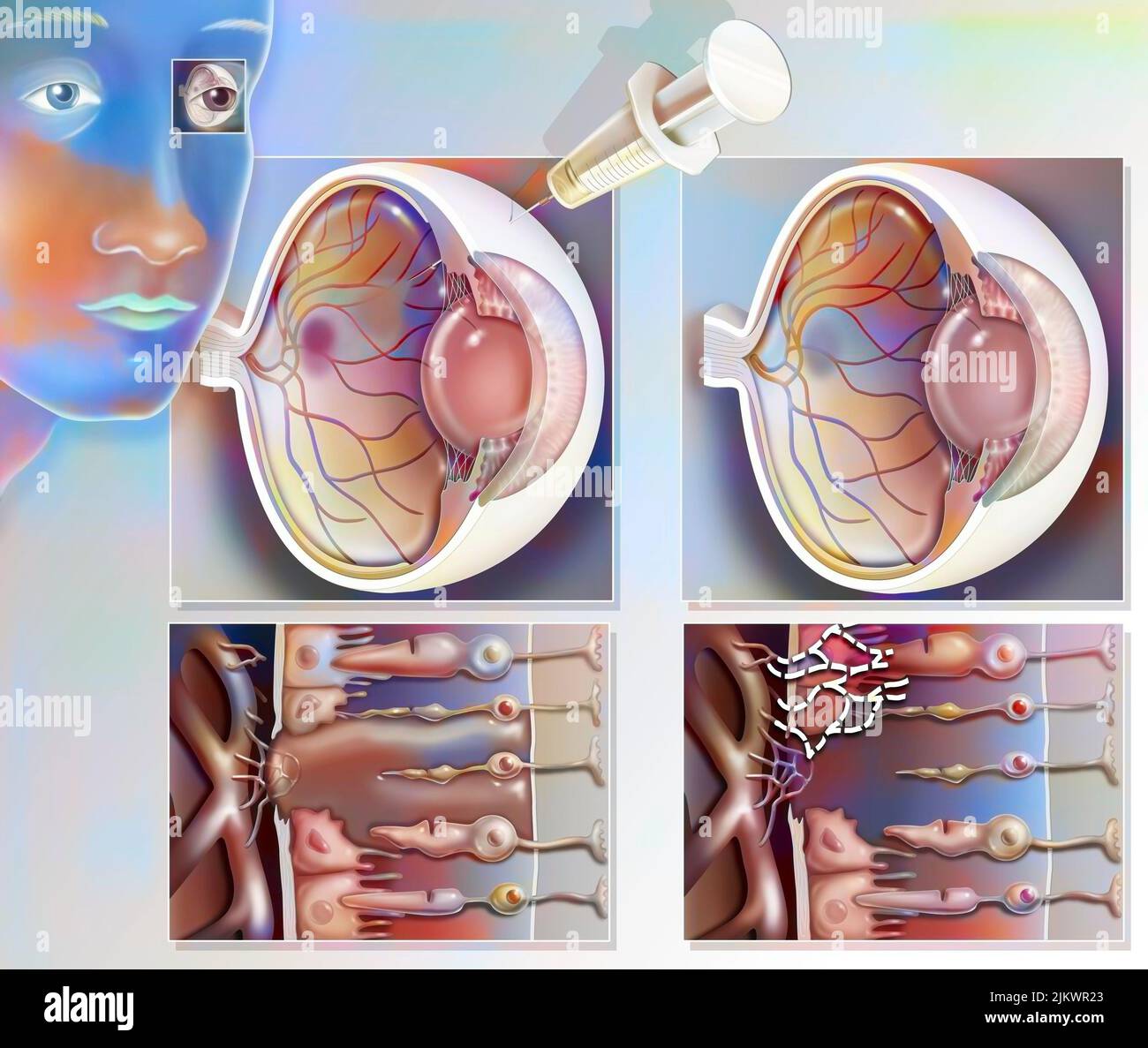 Treatment of macular degeneration by injection of RNA interference. Stock Photo