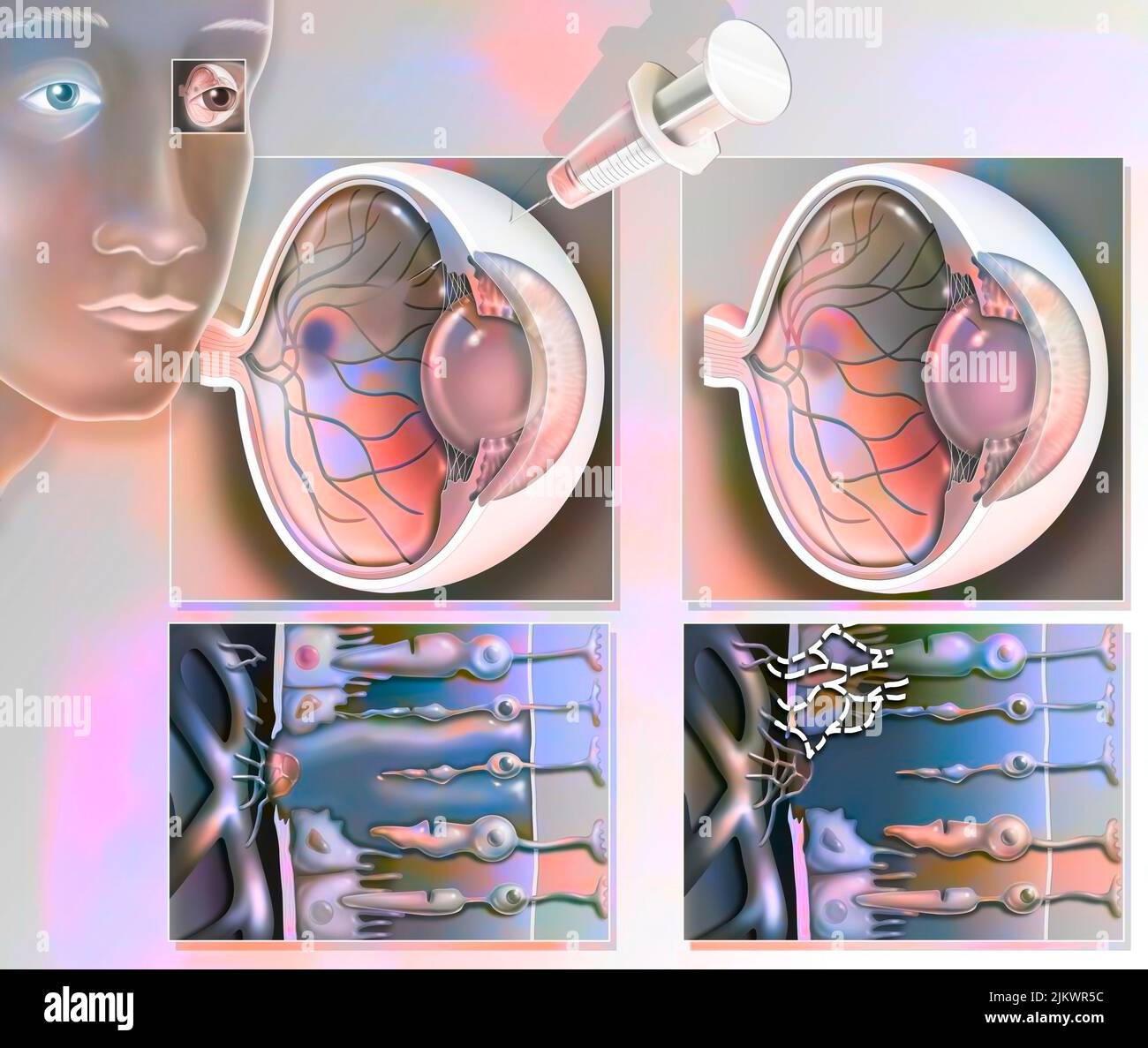 Treatment of macular degeneration by injection of RNA interference Stock Photo Alamy