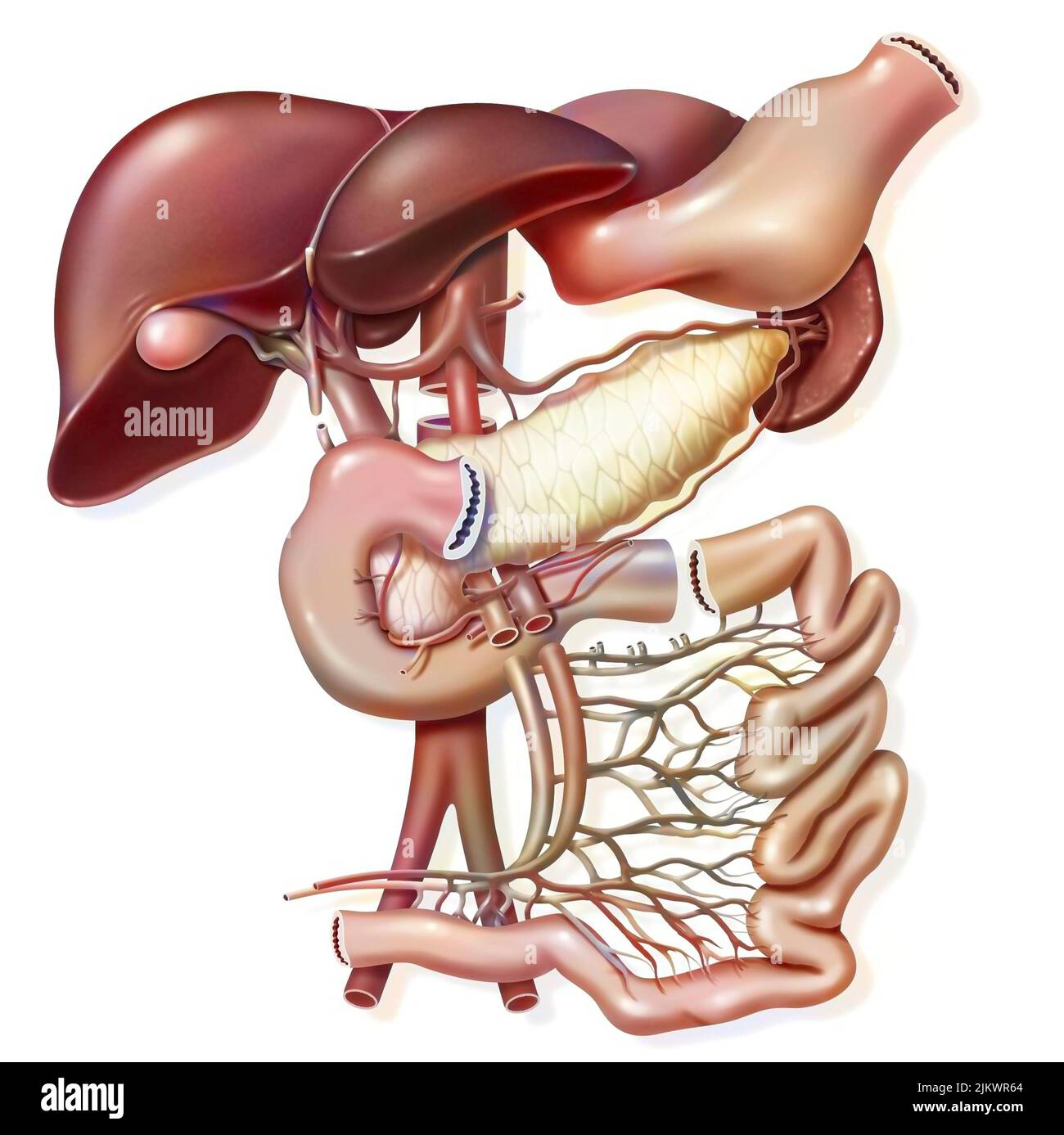 Illustration of a pancreas transplant, graft removal. Stock Photo