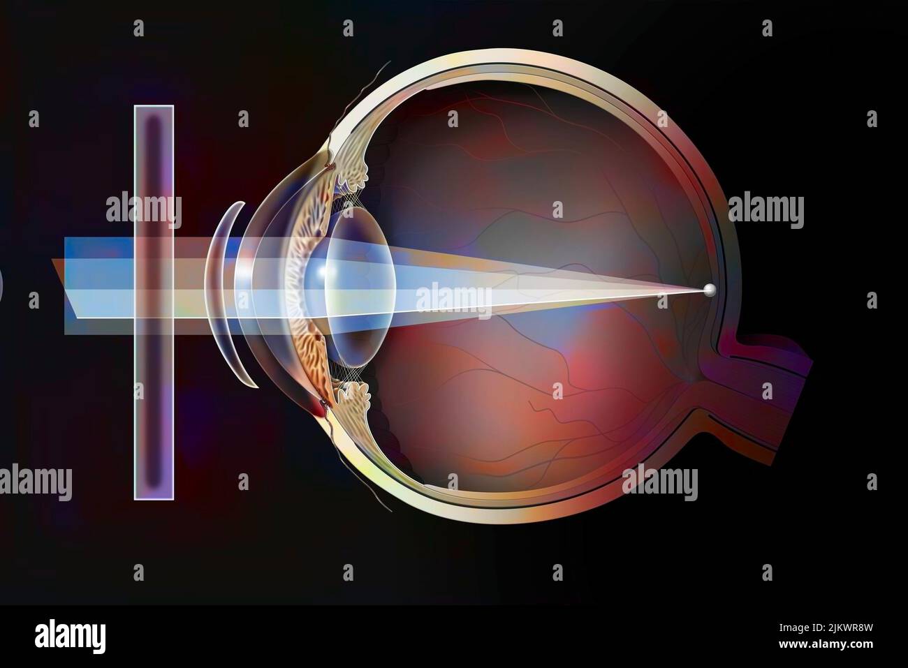 Various possible corrections on an astigmatic eye: spectacle lenses, external lenses. Stock Photo