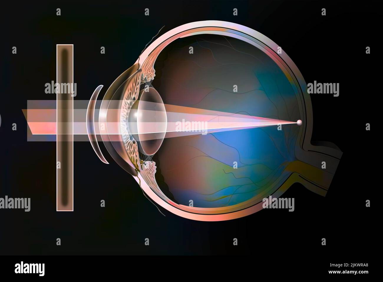 Various possible corrections on an astigmatic eye: spectacle lenses, external lenses. Stock Photo