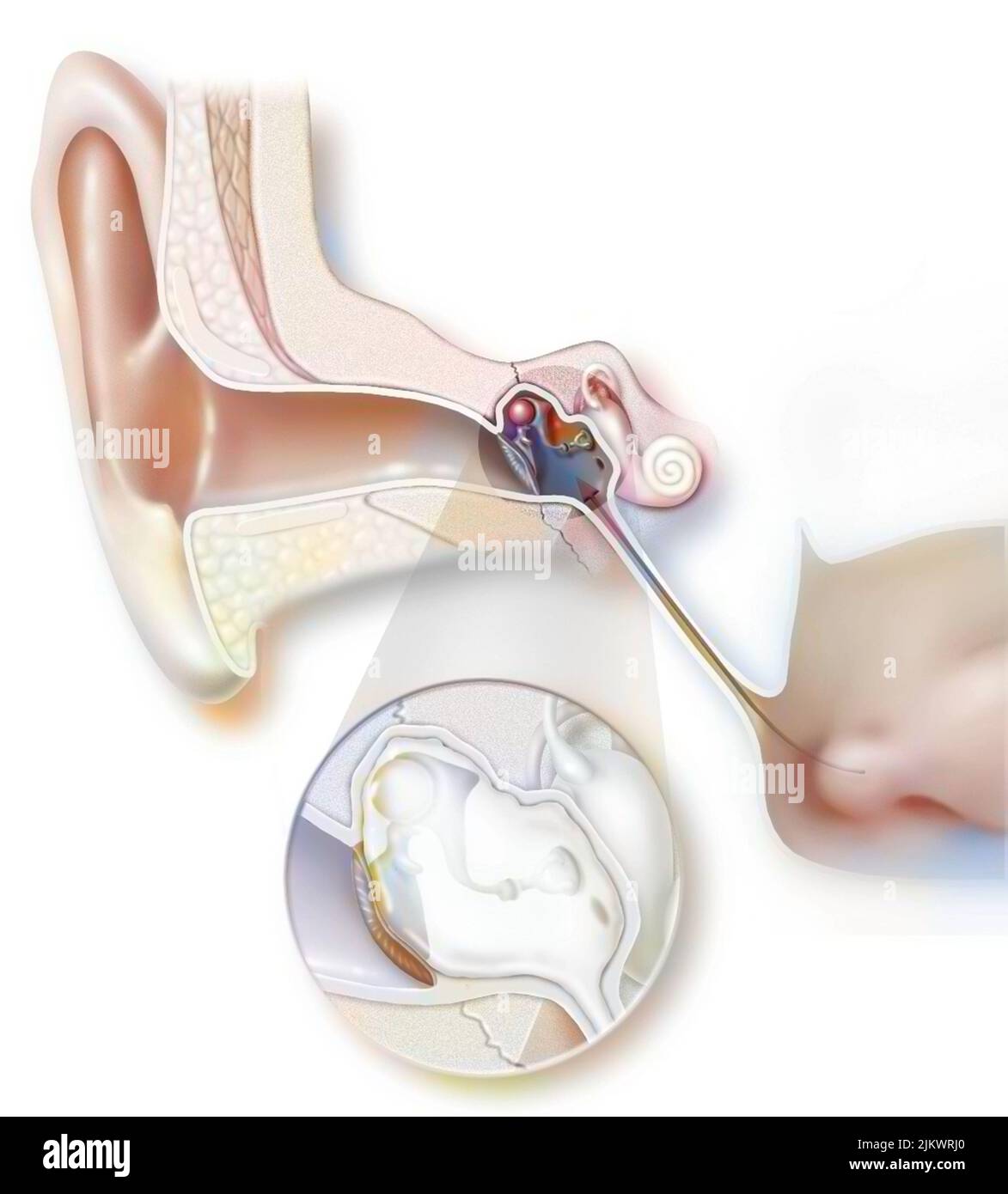 Acute otitis is a bacterial or viral inflammation of the middle ear. Stock Photo